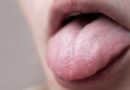 La langue blanche : causes et traitements