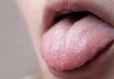 La langue blanche : causes et traitements