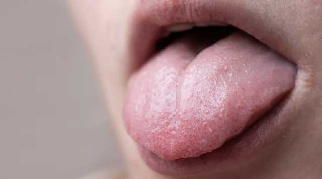 La langue blanche : causes et traitements