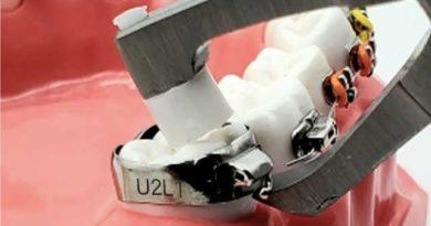 L'importance des bagues molaires avec taquets en orthodontie