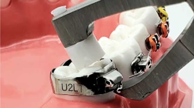 L'importance des bagues molaires avec taquets en orthodontie
