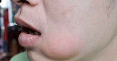 Comment prévenir une infection après un soin dentaire ?