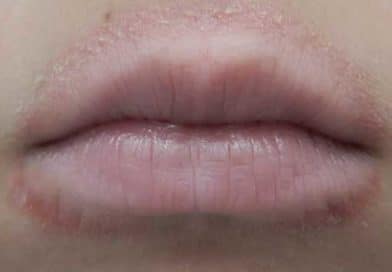 Dermatite périorale et causes d'un anneau rouge autour des lèvres